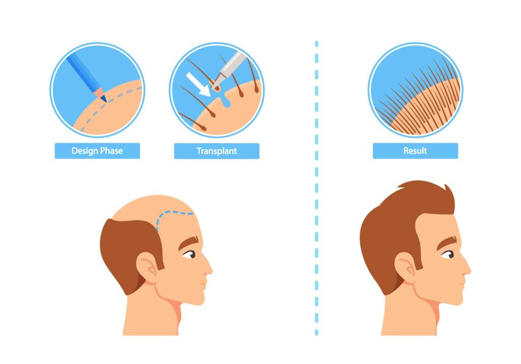 hair transplant permanent before and after result cartoon